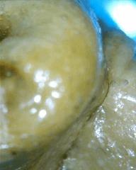 macro extraction DME mal purgé 10