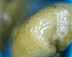 macro extraction DME mal purgé 3