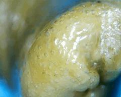 macro extraction DME mal purgé 2