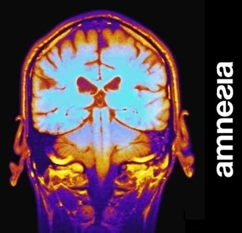 Amnesia - Brain.jpg